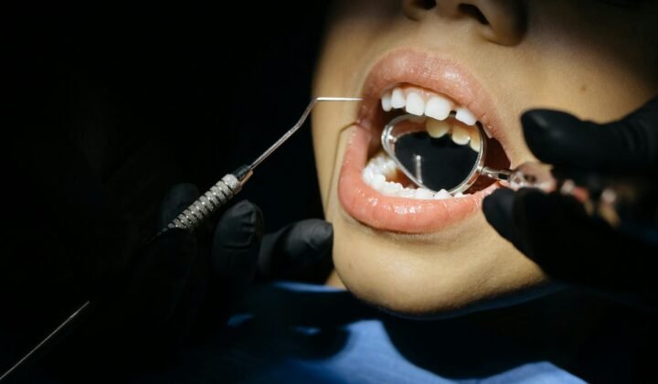 Diş implantı vs protez: fərqlər və xərclər