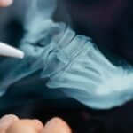 Diz ağrısı: artrit, travma və müalicə üsulları