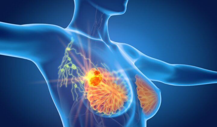 Döş xərçəngi: skriniq müayinələri və erkən diaqnoz